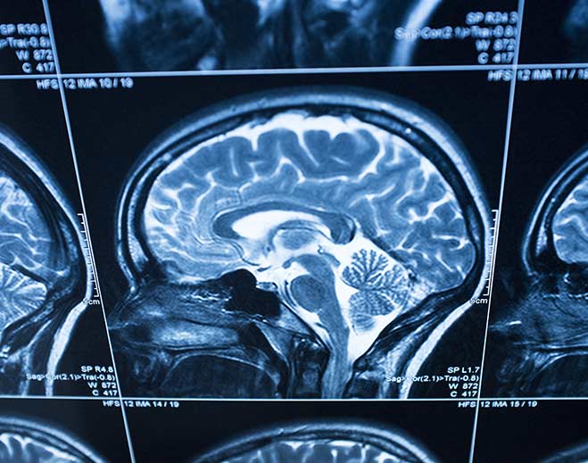 neurology-brain-scan-mrib7323feaa4f163eda0bfff0b00ed1b39